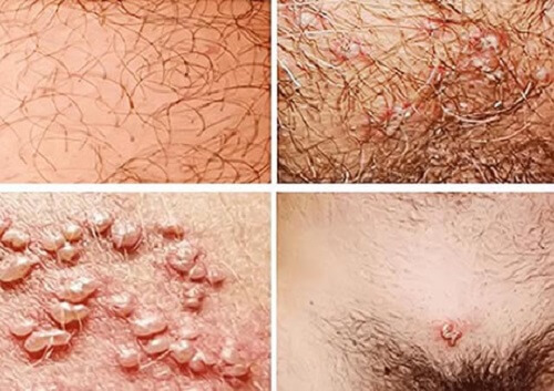 Mọc mụn ở vùng kín nữ 